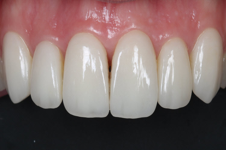 Zirkon kaplamalar (2) Zirkon kaplamalar (2)